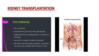 KIDNEY TRANSPLANTATION
 