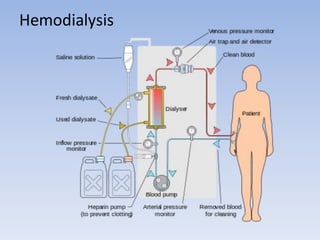 Hemodialysis
 