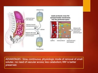 ADVANTAGES : Slow, continuous, physiologic mode of removal of small
solutes ; no need of vascular access; less catabolism; RRF is better
preserved.
 