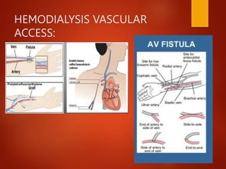 HEMODIALYSIS VASCULAR
ACCESS:
 