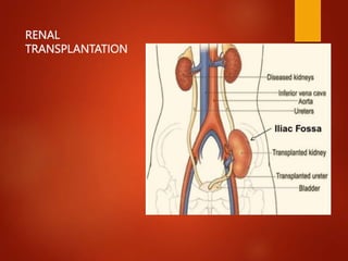 RENAL
TRANSPLANTATION
 