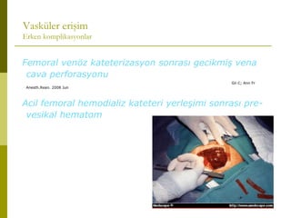 Vasküler erişim
Erken komplikasyonlar
Femoral venöz kateterizasyon sonrası gecikmiş vena
cava perforasyonu
Gil C; Ann Fr
Anesth.Rean. 2008 Jun
Acil femoral hemodializ kateteri yerleşimi sonrası pre-
vesikal hematom
Huang CC; J Emerg Med. 2008 May 1.
 