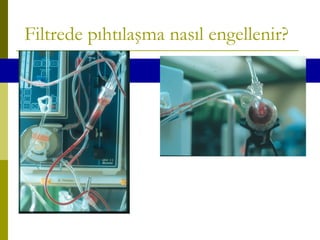 Filtrede pıhtılaşma nasıl engellenir?
43/140 were lost
this way (30.3%)
 