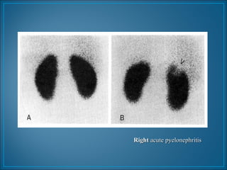 RightRight acute pyelonephritisacute pyelonephritis
 