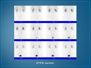 DTPA normalDTPA normal
 