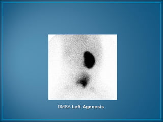 DMSADMSA Left AgenesisLeft Agenesis
 