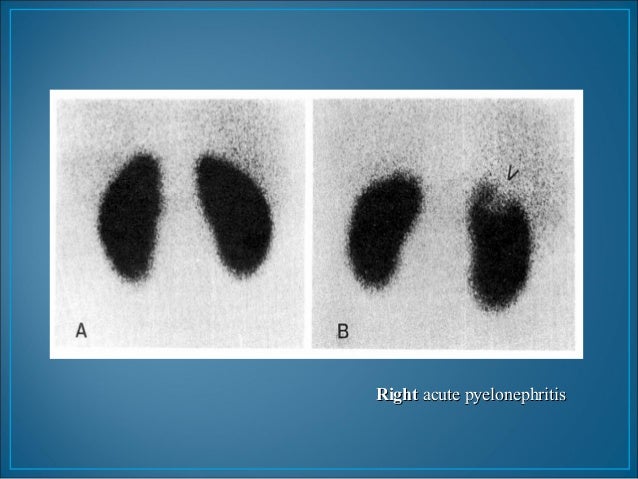 Mag3 renal scan with lasix