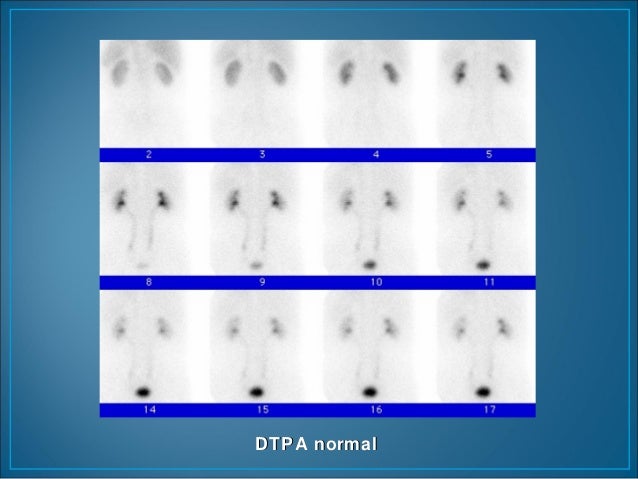 Mag3 renal scan with lasix
