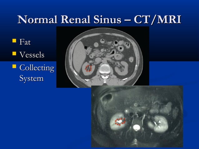 Sinus Rénaux Renal sinus | PPT