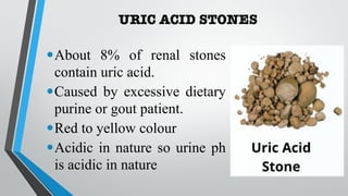 URIC ACID STONES
•About 8% of renal stones
contain uric acid.
•Caused by excessive dietary
purine or gout patient.
•Red to yellow colour
•Acidic in nature so urine ph
is acidic in nature
 