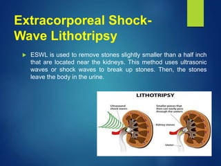 Extracorporeal Shock-
Wave Lithotripsy
 ESWL is used to remove stones slightly smaller than a half inch
that are located near the kidneys. This method uses ultrasonic
waves or shock waves to break up stones. Then, the stones
leave the body in the urine.
 