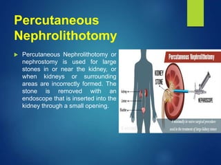 Percutaneous
Nephrolithotomy
 Percutaneous Nephrolithotomy or
nephrostomy is used for large
stones in or near the kidney, or
when kidneys or surrounding
areas are incorrectly formed. The
stone is removed with an
endoscope that is inserted into the
kidney through a small opening.
 