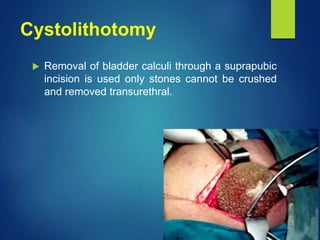 Cystolithotomy
 Removal of bladder calculi through a suprapubic
incision is used only stones cannot be crushed
and removed transurethral.
 