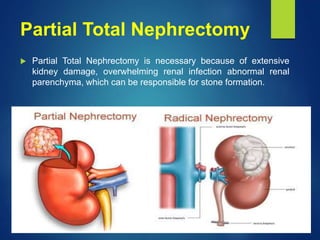 Partial Total Nephrectomy
 Partial Total Nephrectomy is necessary because of extensive
kidney damage, overwhelming renal infection abnormal renal
parenchyma, which can be responsible for stone formation.
 