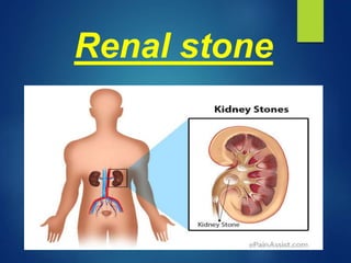 Renal stone
 