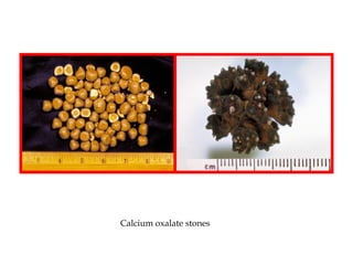 Calcium oxalate stones
 