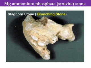 Mg ammonium phosphate (struvite) stone
Staghorn Stone ( Branching Stone)
 