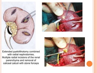 Renal stones ASI bgk.pptx