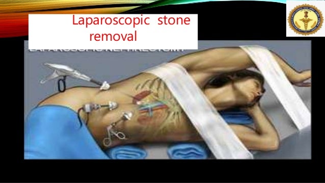 Kidney Stone By Dr Anil Kumar Associate Professor Aiims Patna