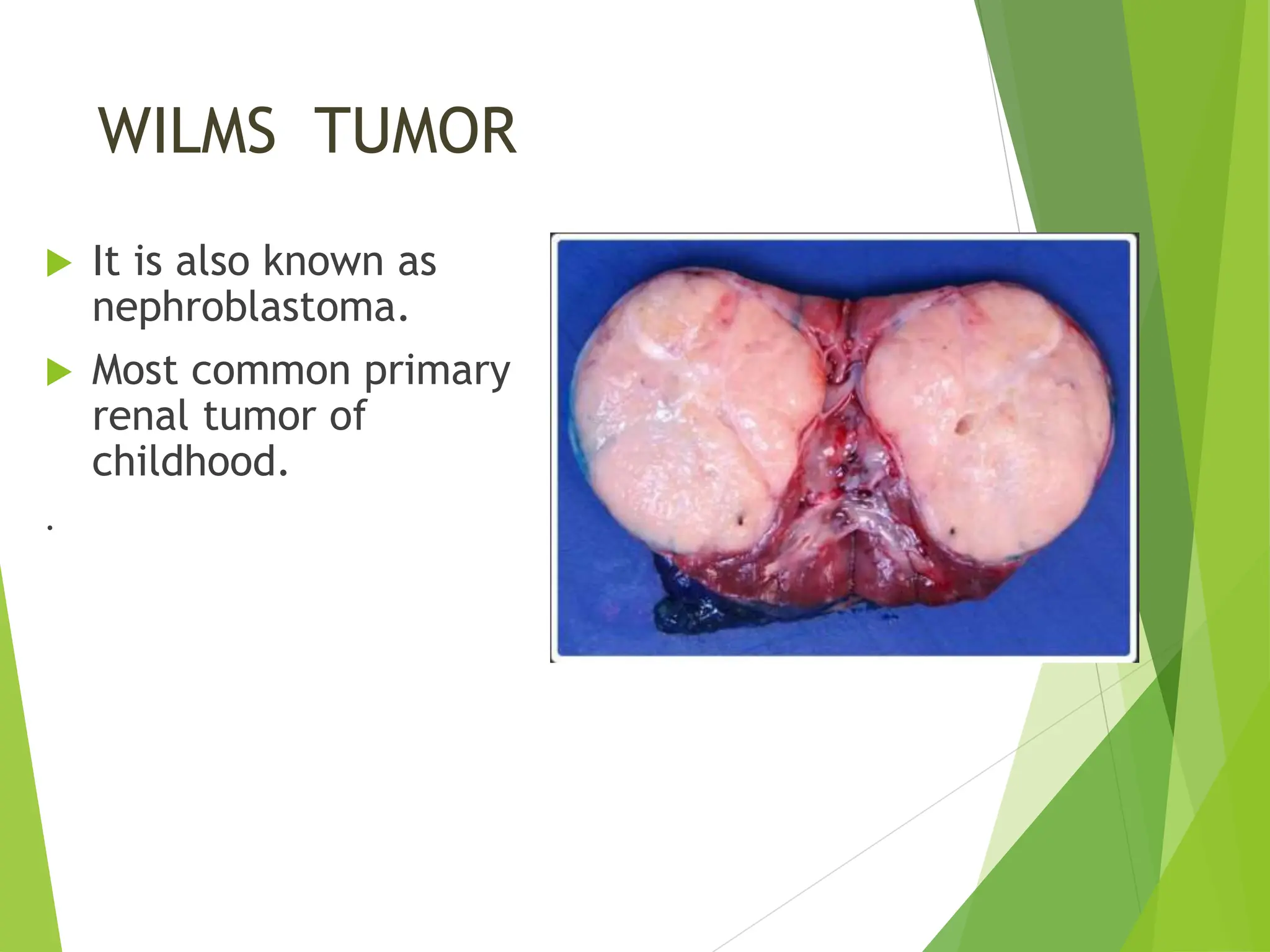  It is also known as
nephroblastoma.
 Most common primary
renal tumor of
childhood.
.
WILMS TUMOR
 
