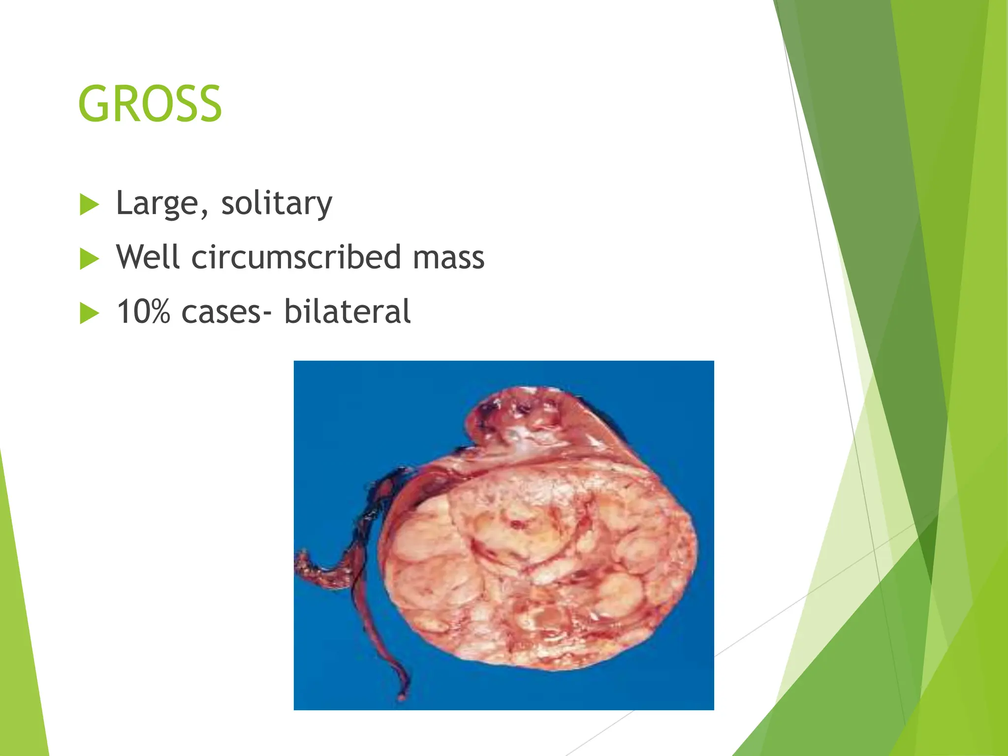 GROSS
 Large, solitary
 Well circumscribed mass
 10% cases- bilateral
 