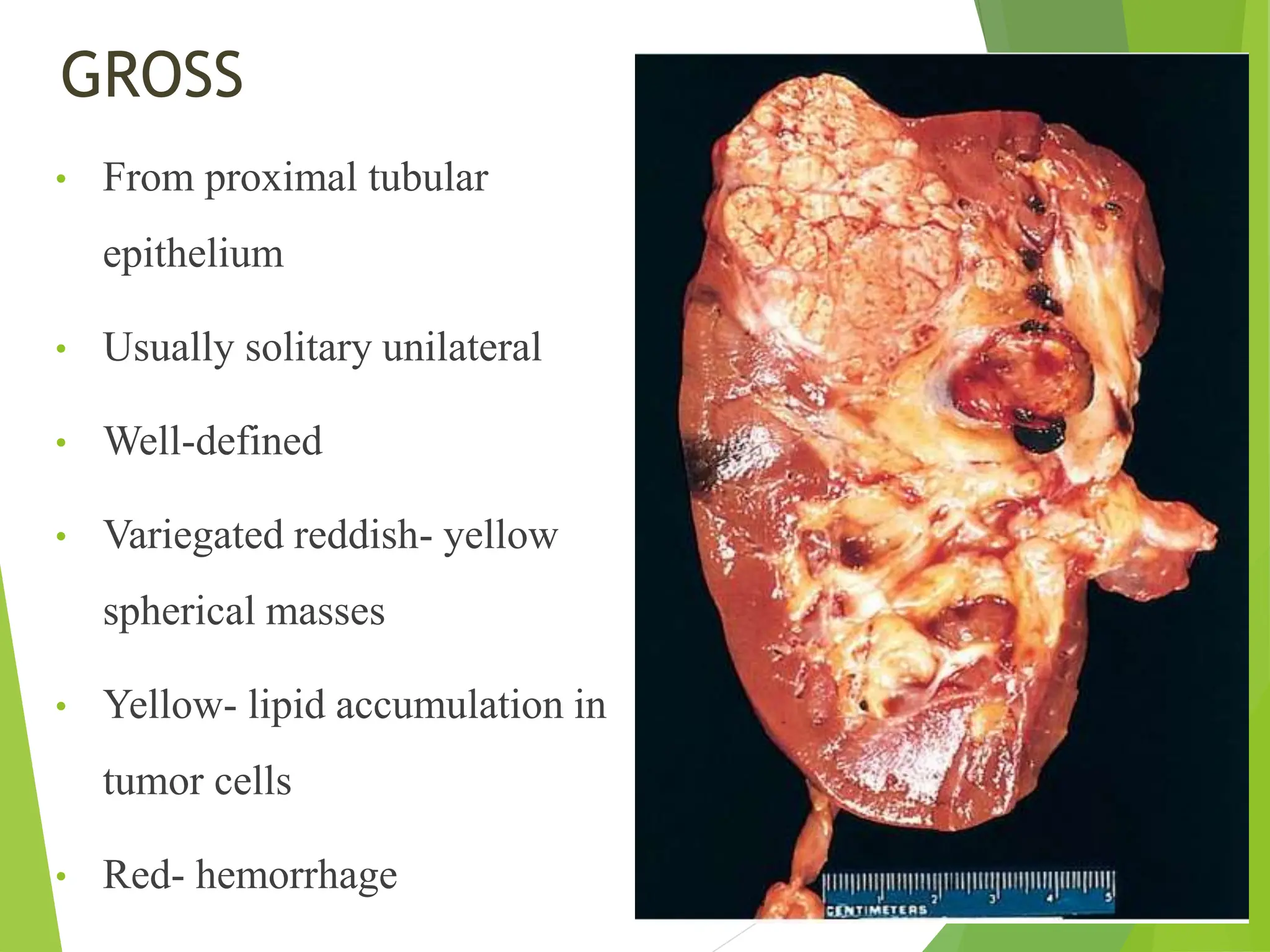 GROSS
• From proximal tubular
epithelium
• Usually solitary unilateral
• Well-defined
• Variegated reddish- yellow
spherical masses
• Yellow- lipid accumulation in
tumor cells
• Red- hemorrhage
 