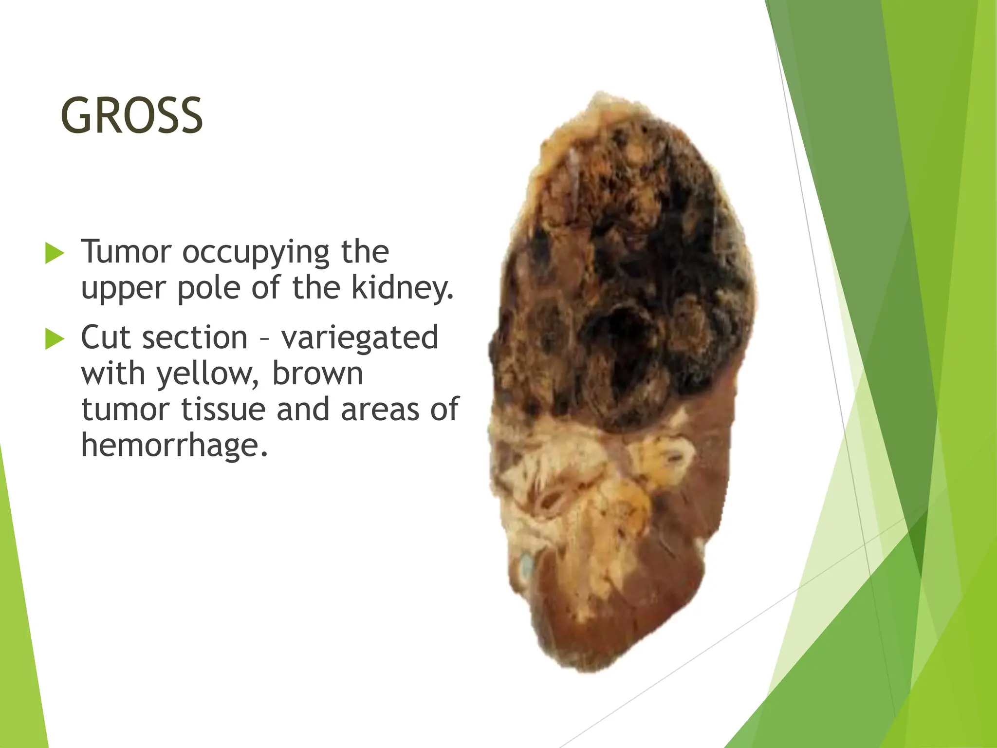 GROSS
 Tumor occupying the
upper pole of the kidney.
 Cut section – variegated
with yellow, brown
tumor tissue and areas of
hemorrhage.
 