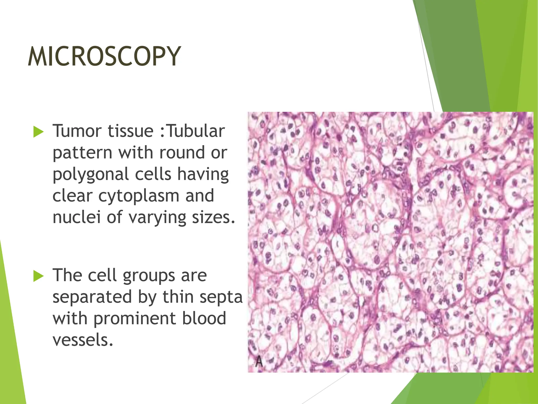 MICROSCOPY
 Tumor tissue :Tubular
pattern with round or
polygonal cells having
clear cytoplasm and
nuclei of varying sizes.
 The cell groups are
separated by thin septa
with prominent blood
vessels.
 