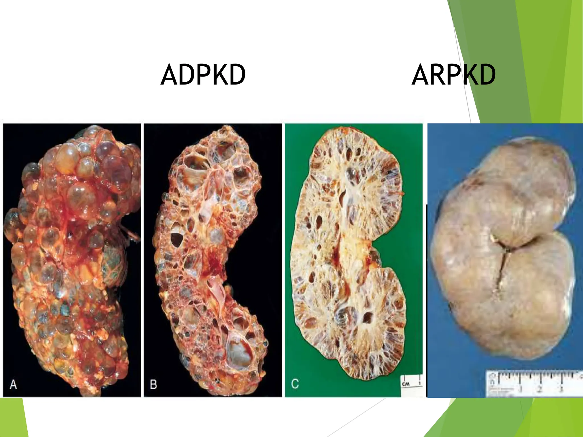 ADPKD ARPKD
 