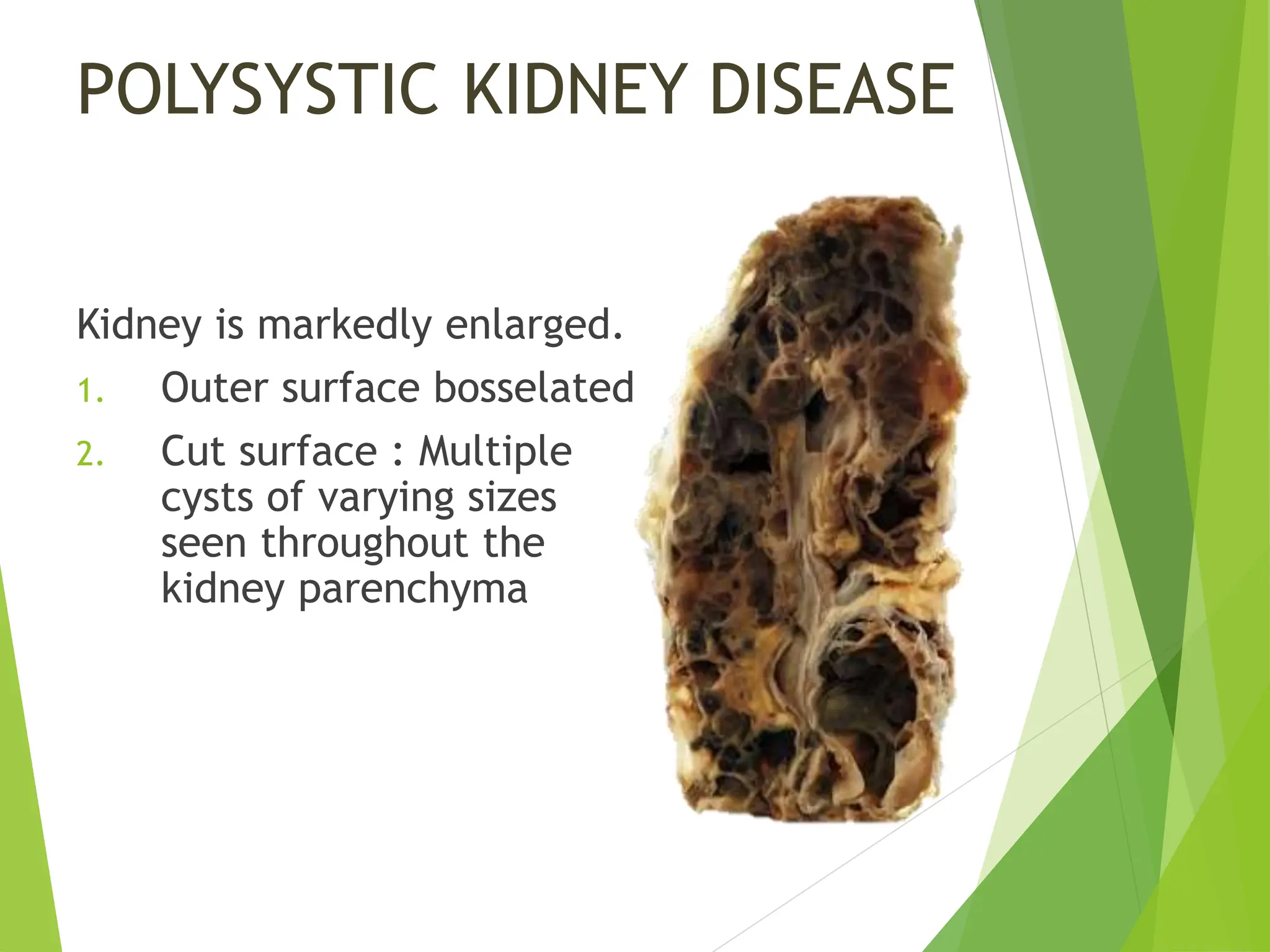 POLYSYSTIC KIDNEY DISEASE
Kidney is markedly enlarged.
1. Outer surface bosselated
2. Cut surface : Multiple
cysts of varying sizes
seen throughout the
kidney parenchyma
 