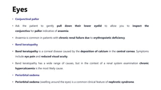 Eyes
• Conjunctival pallor
• Ask the patient to gently pull down their lower eyelid to allow you to inspect the
conjunctiva for pallor indicative of anaemia.
• Anaemia is common in patients with chronic renal failure due to erythropoietic deficiency.
• Band keratopathy
• Band keratopathy is a corneal disease caused by the deposition of calcium in the central cornea. Symptoms
include eye pain and reduced visual acuity.
• Band keratopathy has a wide range of causes, but in the context of a renal system examination chronic
hypercalcaemia is the most likely cause.
• Periorbital oedema
• Periorbital oedema (swelling around the eyes) is a common clinical feature of nephrotic syndrome.
 