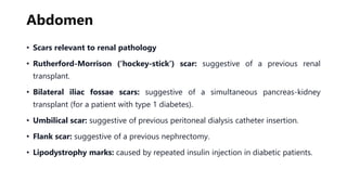 Abdomen
• Scars relevant to renal pathology
• Rutherford-Morrison (‘hockey-stick’) scar: suggestive of a previous renal
transplant.
• Bilateral iliac fossae scars: suggestive of a simultaneous pancreas-kidney
transplant (for a patient with type 1 diabetes).
• Umbilical scar: suggestive of previous peritoneal dialysis catheter insertion.
• Flank scar: suggestive of a previous nephrectomy.
• Lipodystrophy marks: caused by repeated insulin injection in diabetic patients.
 
