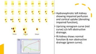 • Hydronephrotic left kidney
showing impaired perfusion
and cortical uptake (denoting
impaired function),
• Uprising renogram curve (red
curve) s/o left obstructive
drainage.
• Rt kidney shows normal
function & non obstructive
drainage (green curve).
 