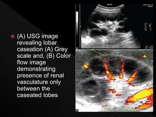 Caseated Renal tuberculosis radiology | PPTX