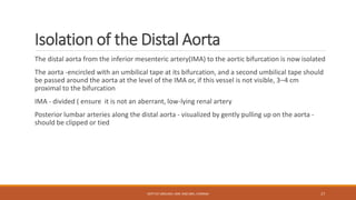 Isolation of the Distal Aorta
The distal aorta from the inferior mesenteric artery(IMA) to the aortic bifurcation is now isolated
The aorta -encircled with an umbilical tape at its bifurcation, and a second umbilical tape should
be passed around the aorta at the level of the IMA or, if this vessel is not visible, 3–4 cm
proximal to the bifurcation
IMA - divided ( ensure it is not an aberrant, low-lying renal artery
Posterior lumbar arteries along the distal aorta - visualized by gently pulling up on the aorta -
should be clipped or tied
DEPT OF UROLOGY, KMC AND GRH, CHENNAI 17
 