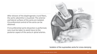 After division of the diaphragmatic crural fibers,
the aortic adventitia is visualized. The anterior
and lateral surfaces of the aorta are isolated.
Circumferential control of the aorta can be
obtained.
If circumferential aortic dissection is performed,
care must be taken to avoid injury to the
posterior aspect of the aorta or spinal arteries.
Isolation of the supraceliac aorta for cross-clamping
DEPT OF UROLOGY, KMC AND GRH, CHENNAI 20
 