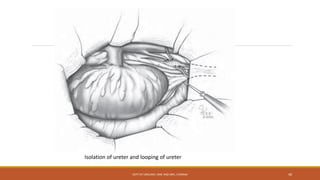 Isolation of ureter and looping of ureter
DEPT OF UROLOGY, KMC AND GRH, CHENNAI 40
 