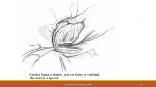 Gerota’s fascia is entered, and the kidney is mobilized.
The adrenal is spared
DEPT OF UROLOGY, KMC AND GRH, CHENNAI 41
 