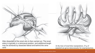 Hilar dissection of the renal vein is then carried out. The renal
artery is typically in a retrocaval position, and additional length
may be achieved by dissected lateral and behind the vena
cava
At the time of renal hilar manipulation, 25 g of
mannitol are given intravenously for renal protection.
DEPT OF UROLOGY, KMC AND GRH, CHENNAI 42
 