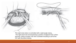 The right renal artery is controlled with a right-angle clamp.
The right renal vein encompassing a portion of adjacent IVC is then
secured. Using a scissor, the vein is divided including a cuff of the
IVC with the donor kidney.
DEPT OF UROLOGY, KMC AND GRH, CHENNAI 44
 