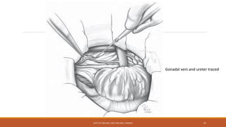 Gonadal vein and ureter traced
DEPT OF UROLOGY, KMC AND GRH, CHENNAI 47
 