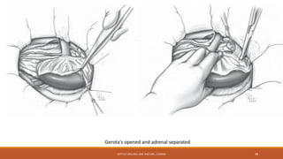 Gerota's opened and adrenal separated
DEPT OF UROLOGY, KMC AND GRH, CHENNAI 48
 