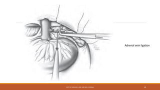 Adrenal vein ligation
DEPT OF UROLOGY, KMC AND GRH, CHENNAI 49
 