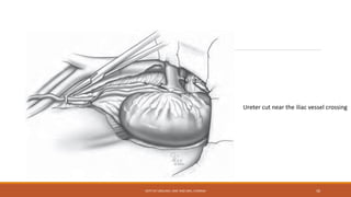 Ureter cut near the iliac vessel crossing
DEPT OF UROLOGY, KMC AND GRH, CHENNAI 50
 