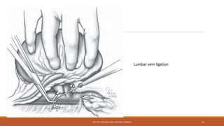 Lumbar vein ligation
DEPT OF UROLOGY, KMC AND GRH, CHENNAI 51
 