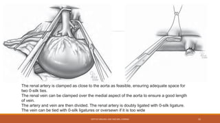 The renal artery is clamped as close to the aorta as feasible, ensuring adequate space for
two 0-silk ties.
The renal vein can be clamped over the medial aspect of the aorta to ensure a good length
of vein.
The artery and vein are then divided. The renal artery is doubly ligated with 0-silk ligature.
The vein can be tied with 0-silk ligatures or oversewn if it is too wide
DEPT OF UROLOGY, KMC AND GRH, CHENNAI 52
 