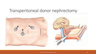 Transperitoneal donor nephrectomy
DEPT OF UROLOGY, KMC AND GRH, CHENNAI 56
 