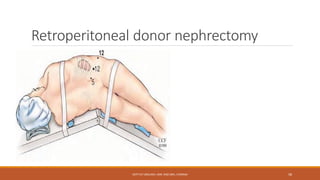 Retroperitoneal donor nephrectomy
DEPT OF UROLOGY, KMC AND GRH, CHENNAI 58
 