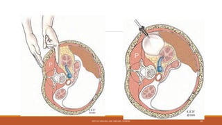 DEPT OF UROLOGY, KMC AND GRH, CHENNAI 59
 