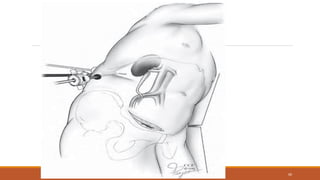 DEPT OF UROLOGY, KMC AND GRH, CHENNAI 60
 